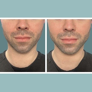 Juvederm VOLUX is Defining Jawline Enhancement