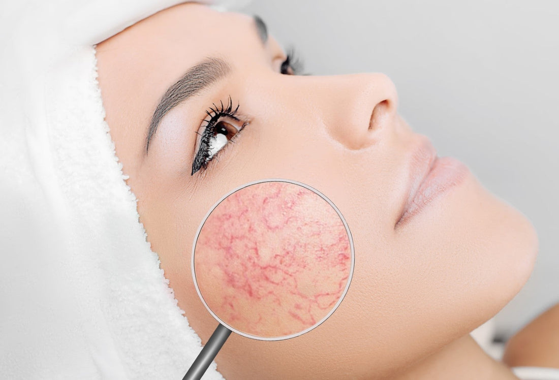 Dear #AYA: How to Effectively Deal with Rosacea