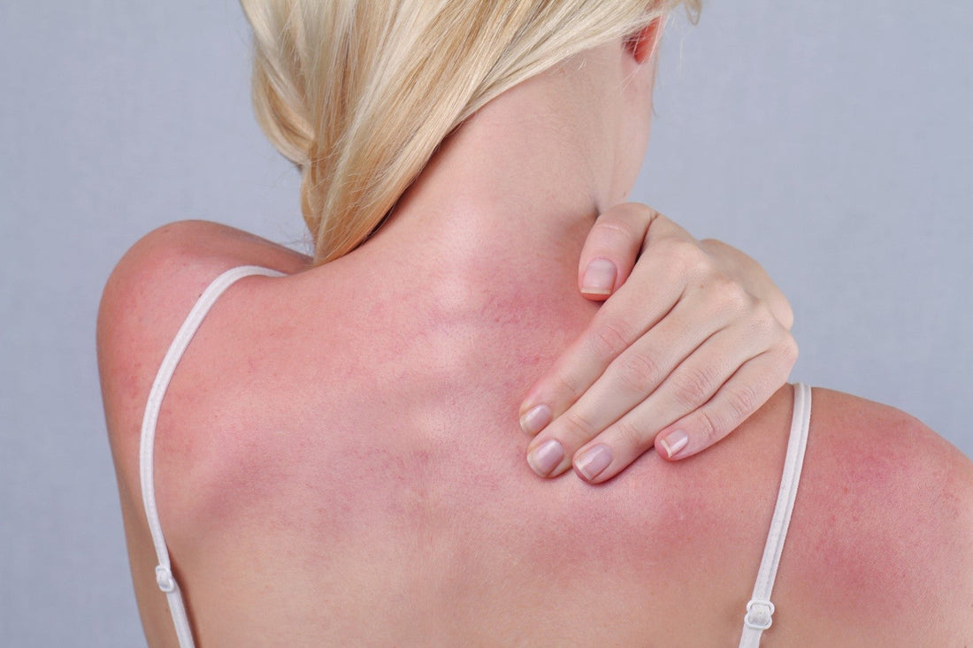 Dear #AYA: How to Refresh Sun Damaged Skin