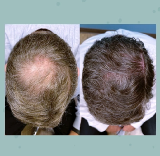 Revolutionary Hair Restoration and Cellulite Treatments
