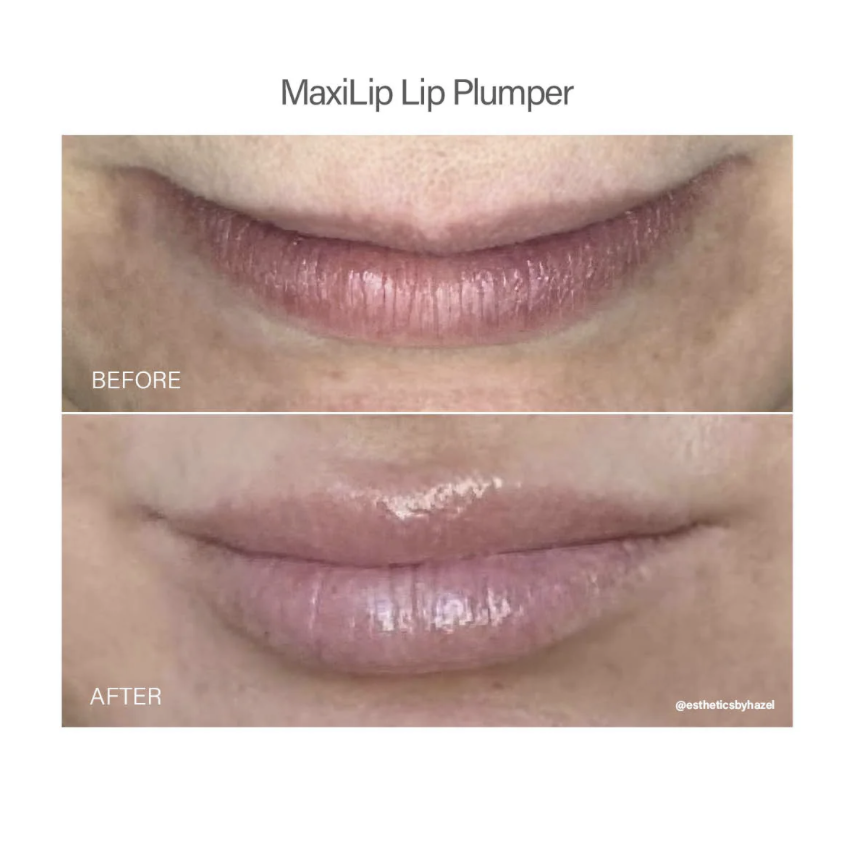 MaxiLip Lip Plumper before and after treatment