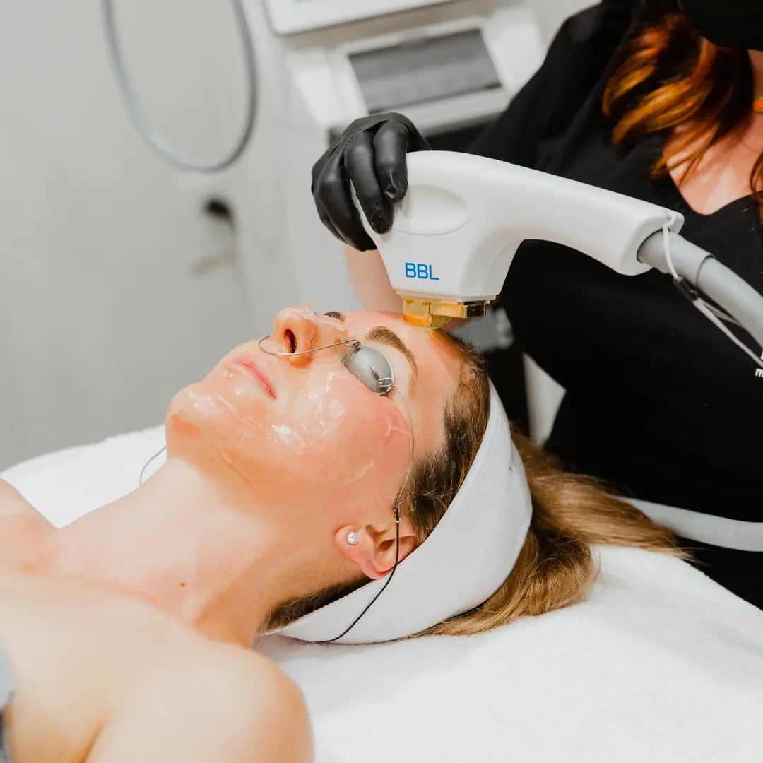 BBL light treatment for sun damage and uneven skin tone